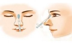 玻尿酸隆鼻真的會變寬嗎?