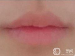 嘴唇外翻矯正的作用是什么?嘴唇外翻整形手術(shù)嗎?