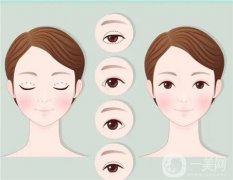 全切雙眼皮和有什么不同？