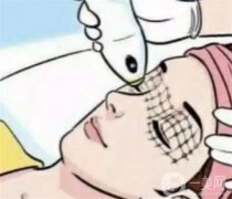 射頻眼部除皺有什么優(yōu)勢?