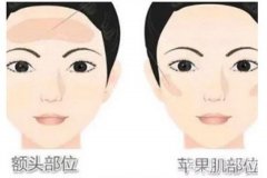 面部可以水動力吸脂嗎，嗎？