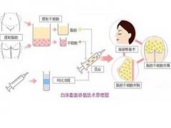 自體脂肪填充會(huì)出現(xiàn)排斥嗎？
