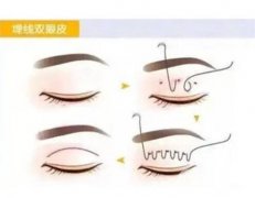 做全切雙眼皮和埋線雙眼皮可以維持多久？