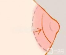 做乳暈縮小手術(shù)是不是很痛呢？