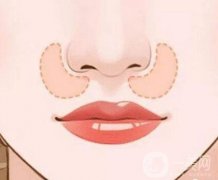 鼻翼縮小的后遺癥有哪些，如何避免?