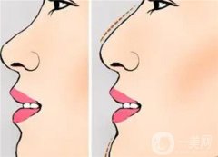 隆鼻修復(fù)的二次傷害應(yīng)該如何避免？