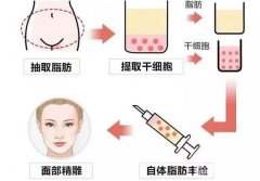 納米脂肪填充有哪些果？