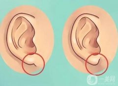 玻尿酸豐耳垂對身體有害嗎？