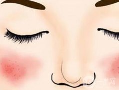 激光去除紅血絲的原理是什么，優(yōu)點是什么