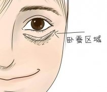 臥蠶注射玻尿酸會下移嗎？是否