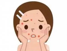 激光祛痘的優(yōu)勢是什么？