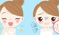 激光可以祛斑的原因？