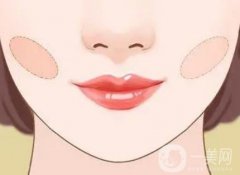 什么是頰脂墊?去除頰脂墊的手術(shù)方法?