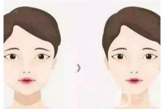 面部吸脂的果是*性的嗎？什么情況會反彈