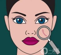 哪些人適合激光除疤?