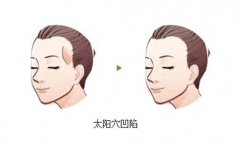 太陽穴凹陷怎么辦？太陽穴填充要多少錢？