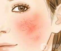 激光調(diào)節(jié)紅血絲多少錢？