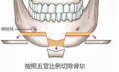 男士下頜角整形果好嗎？多少錢？