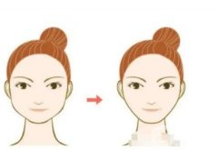 下頜角整形會(huì)導(dǎo)致面部下垂?皮膚松弛嗎?