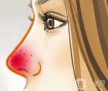 怎么調(diào)節(jié)酒渣鼻？酒渣鼻的調(diào)節(jié)方法是什么？