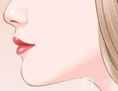 玻尿酸填充鼻唇溝的價(jià)格受哪些因素影響?