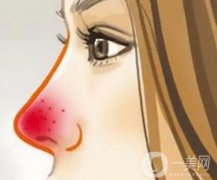 酒糟鼻不同時期的調(diào)節(jié)方法