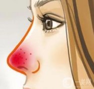 酒渣鼻的預(yù)防與護(hù)理？