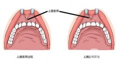 唇系帶是什么?唇系帶異常表現(xiàn)是什么?