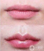 唇珠整形痛嗎?唇峰塑形有哪些注意事項(xiàng)?