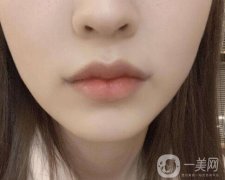微笑唇整形的方法有哪些?