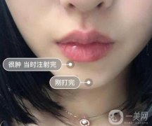 為什么我做了唇部整形卻還是不好看?透明質(zhì)酸豐唇珠是什么?