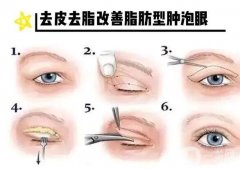 什么是腫泡眼重瞼術(shù)？有哪些方法