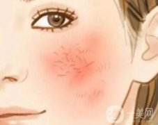 激光去除紅血絲術(shù)后如何護(hù)理？痛不痛？