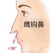 矯正鷹鉤鼻需要假體嗎？鷹鉤鼻矯正的方法？