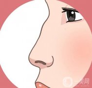 駝峰鼻矯正有哪些后遺癥？如何降低駝峰鼻矯正的風險？