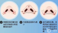 如果鼻翼縮小手術(shù)失敗了怎么辦？鼻翼縮小手術(shù)是如何進行的？