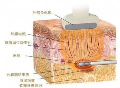 射頻緊膚適合哪些人群？果怎么樣？