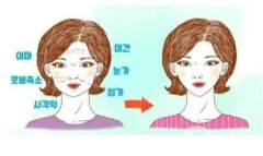 如果做熱瑪吉臉部凹陷怎么辦？如何預(yù)防？