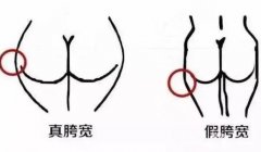 假胯寬能不能抽脂？如何判斷自己是不是假胯寬？