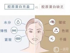 膠原蛋白注射后果能持續(xù)多久？膠原蛋白和玻尿酸的區(qū)別？