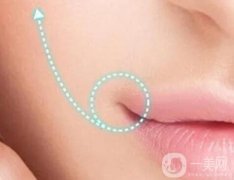 嘴角上揚手術(shù)適合誰？有什么危害