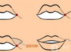嘴角上揚手術會不會留疤？恢復期是多久？