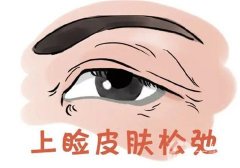 雙眼皮下垂怎么辦？雙眼皮下垂的原因？