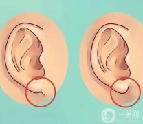 玻尿酸豐耳垂的副作用和危害？