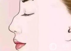 矯正駝峰鼻能維持多久？是*的嗎？