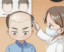種植發(fā)際線的價格是多少?