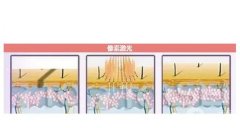 像素激光和點(diǎn)陣激光有哪些區(qū)別？