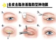 眼皮抽脂有需要忌口的嗎？