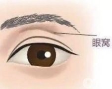 自體脂肪填充的眼窩會不會留下疤痕？填充后有什么影響？