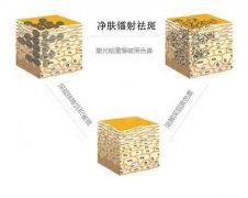 鐳射凈膚有什么果？做一次要多少錢？